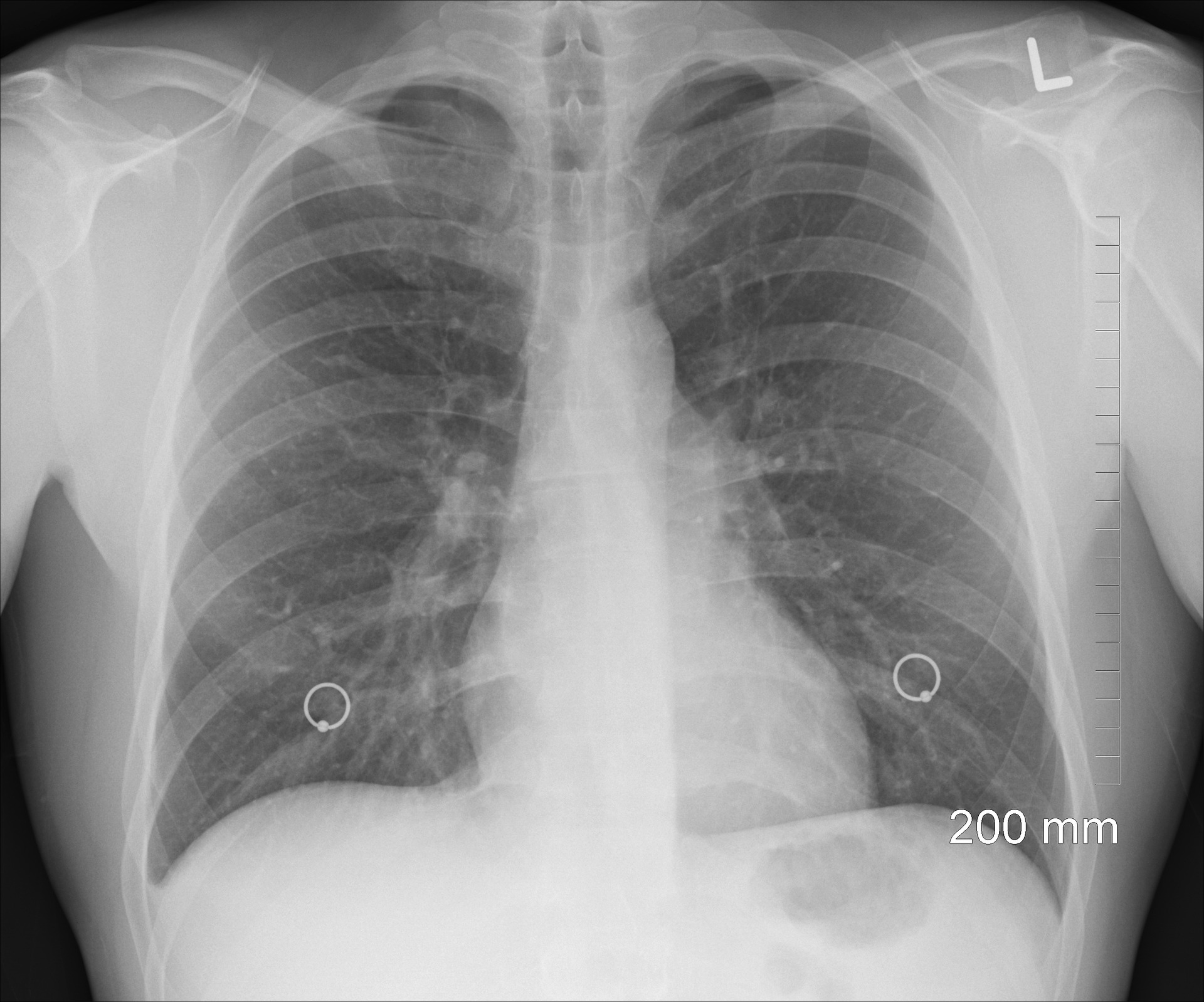 New Medical Research Foundation Grant for Tuberculosis Research