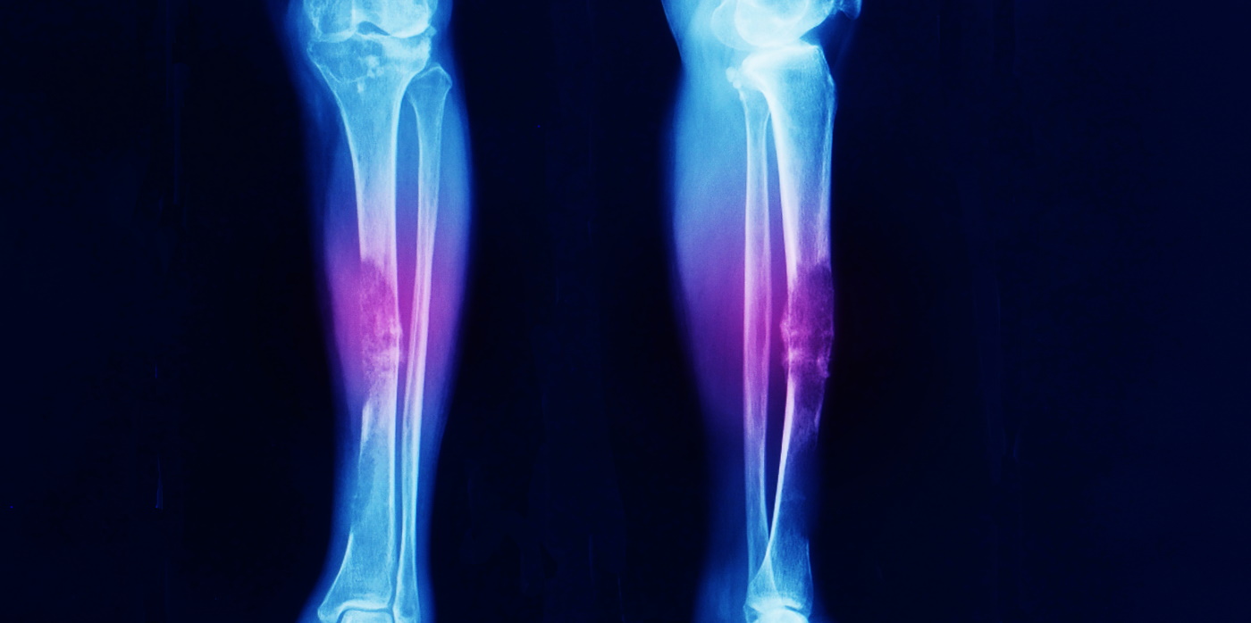 Idox Group News - Leg X-Ray showing advanced sarcoma cancer